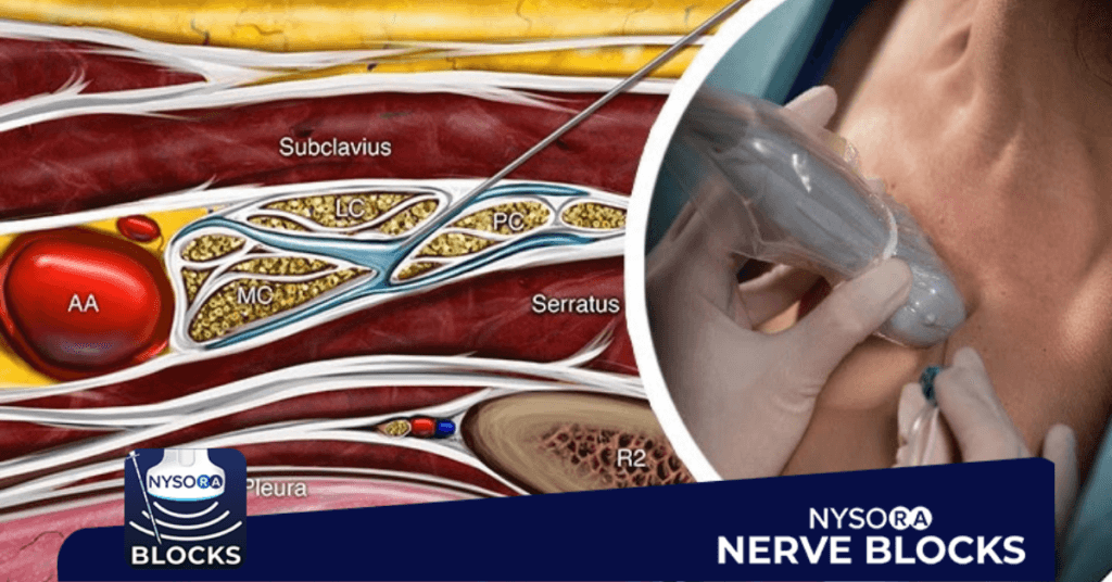 New: Costoclavicular Block