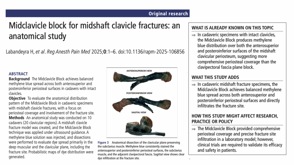 Midclavicle block shows precise anatomical targeting for midshaft clavicle fractures