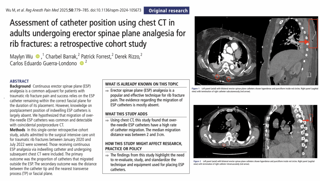 CT imaging reveals high ESP catheter migration in rib fracture analgesia