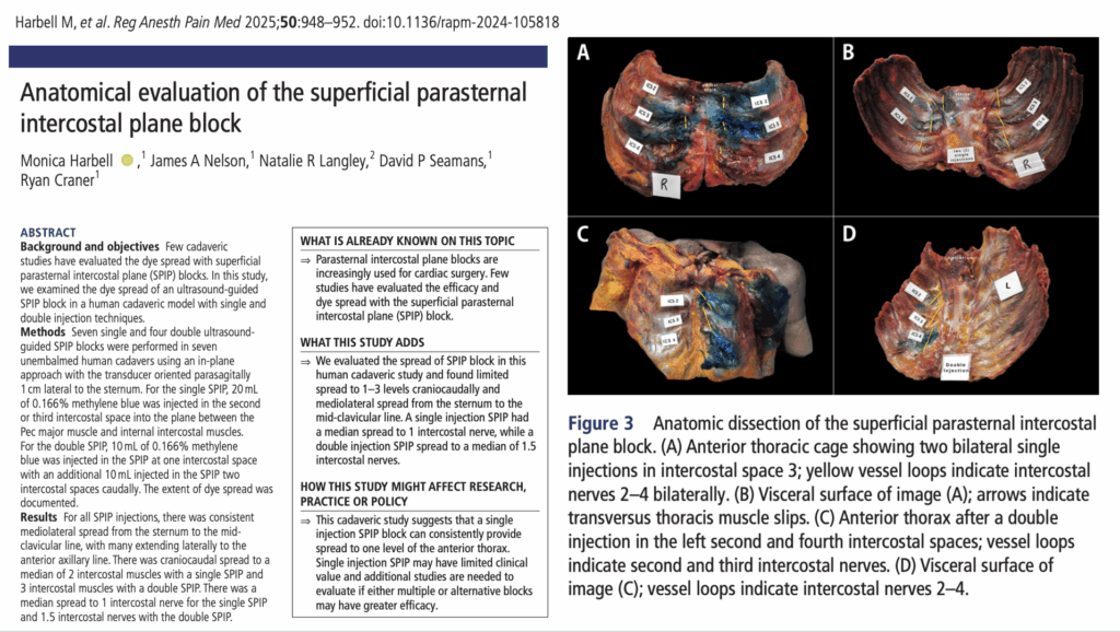How far does a superficial parasternal block really spread?
