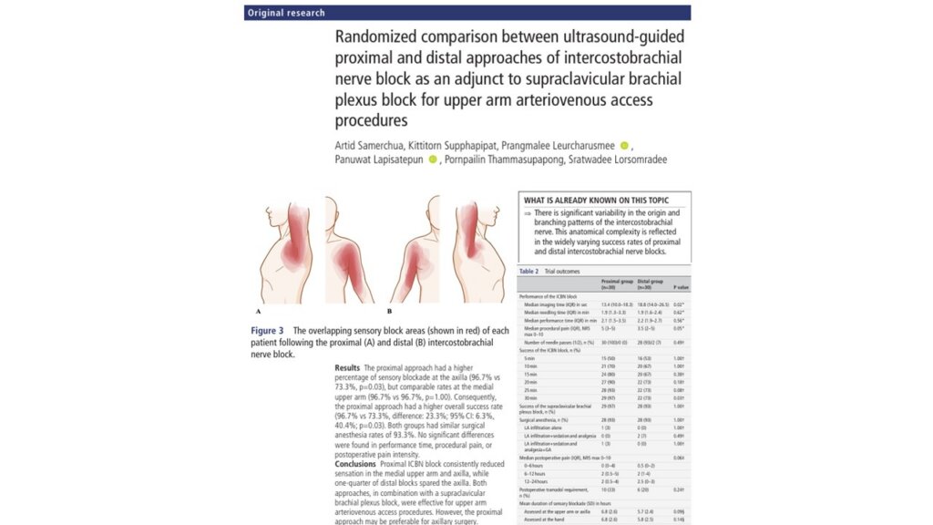 Comparing proximal vs distal ICBN blocks in upper arm AV access surgery: which offers more consistent coverage?